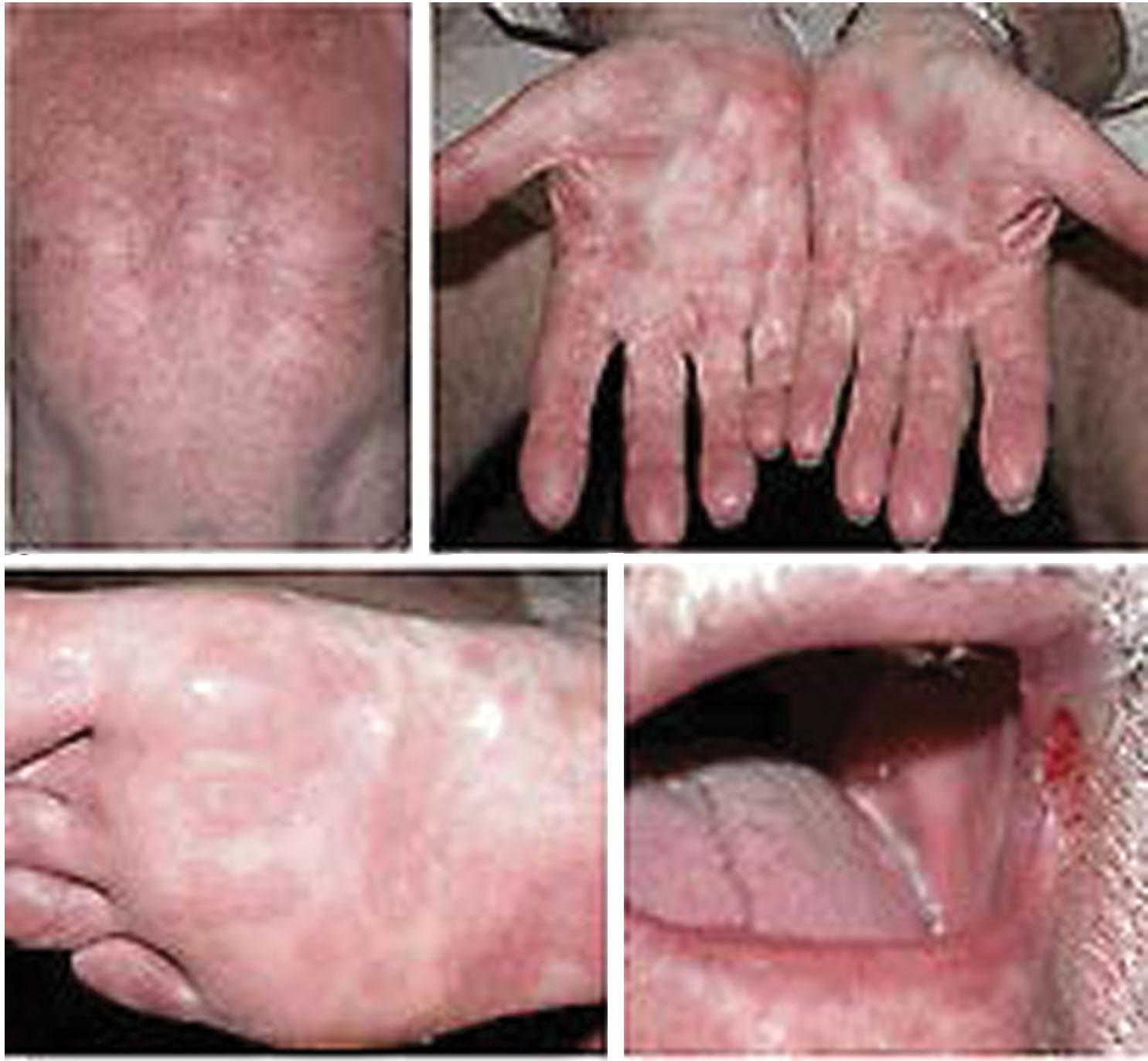 Fig. 23.13, Secondary syphilis: maculopapular rash. Characteristic maculopapular rash of secondary syphilis affecting the trunk (A), palms (B), and soles (C). (D) Angular mouth ulcer in the same patient.