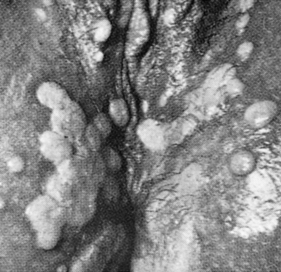 Fig. 23.14, Multiple lesions of condylomata lata on vulva and perineum. Dark-field microscopic findings were positive.