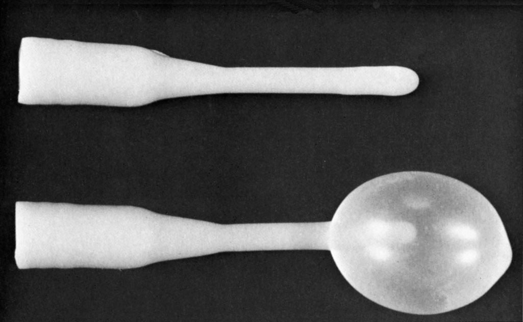 Fig. 23.2, Word catheters before and after inflation. They are used to develop a fistula from a Bartholin cyst or abscess to the vestibule.