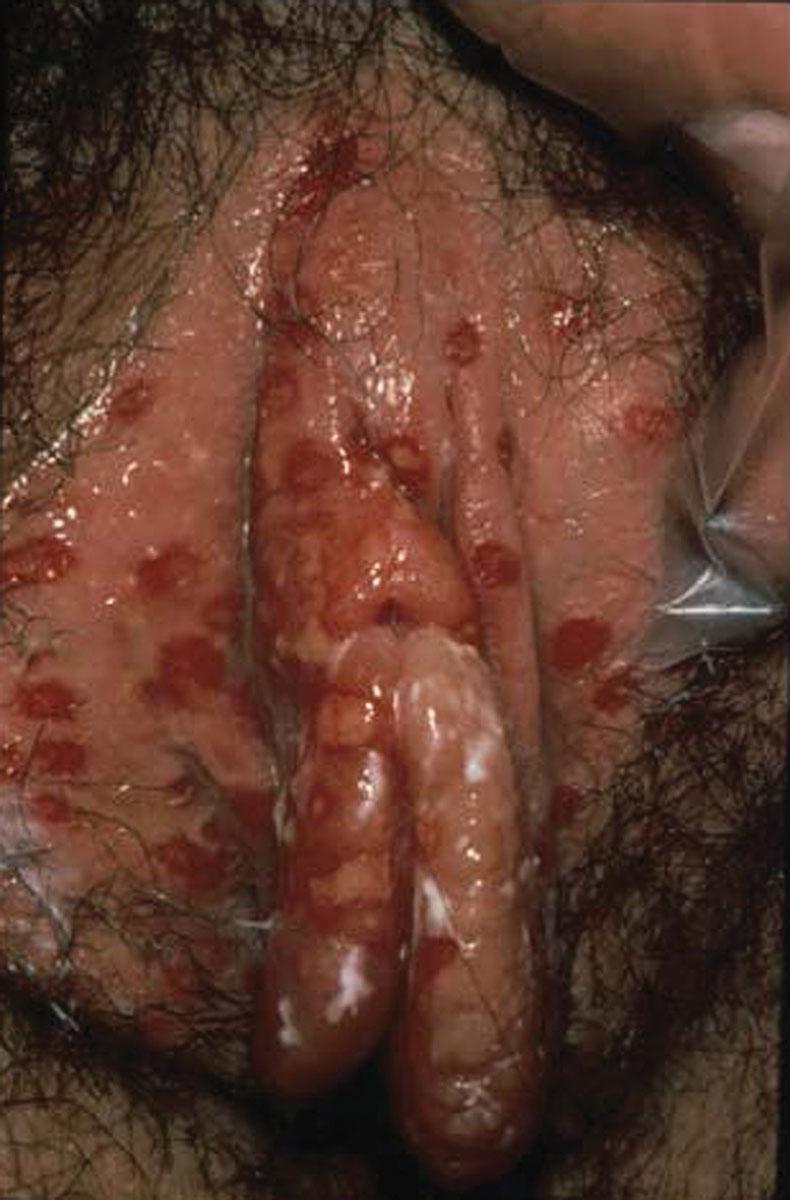 Fig. 23.7, Herpes genitalis. Superficial ulcers are noted following rupture of vesicles.