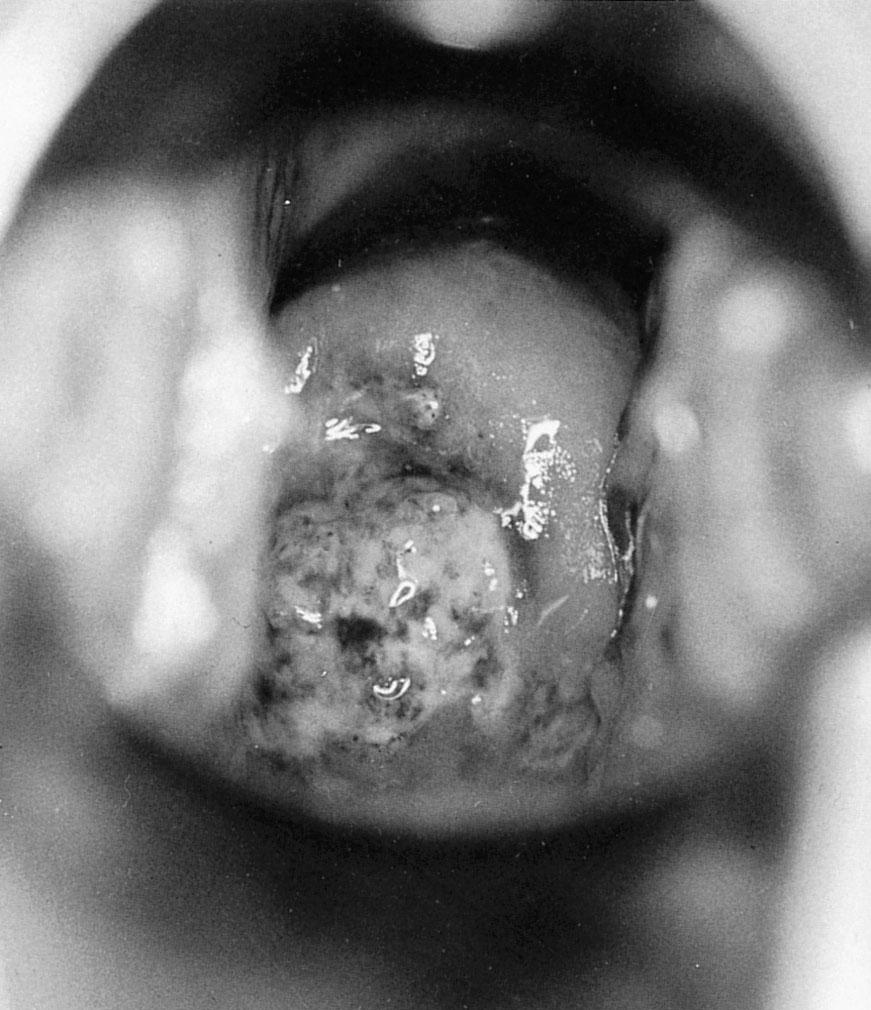 Fig. 23.8, Primary herpes involving the cervix. A necrotic exophytic mass is seen on posterior lip. This was clinically thought to be invasive carcinoma. Herpes simplex virus culture was positive. The lesion spontaneously disappeared.