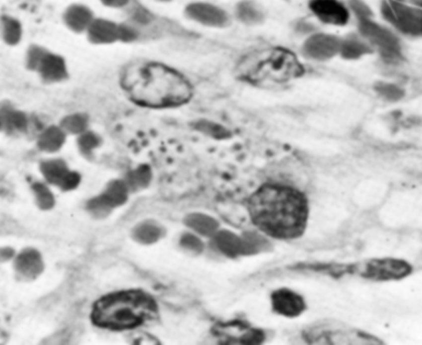 Fig. 23.9, Donovanosis. Biopsy specimen shows intracytoplasmic Donovan bodies (hematoxylin-eosin stain).