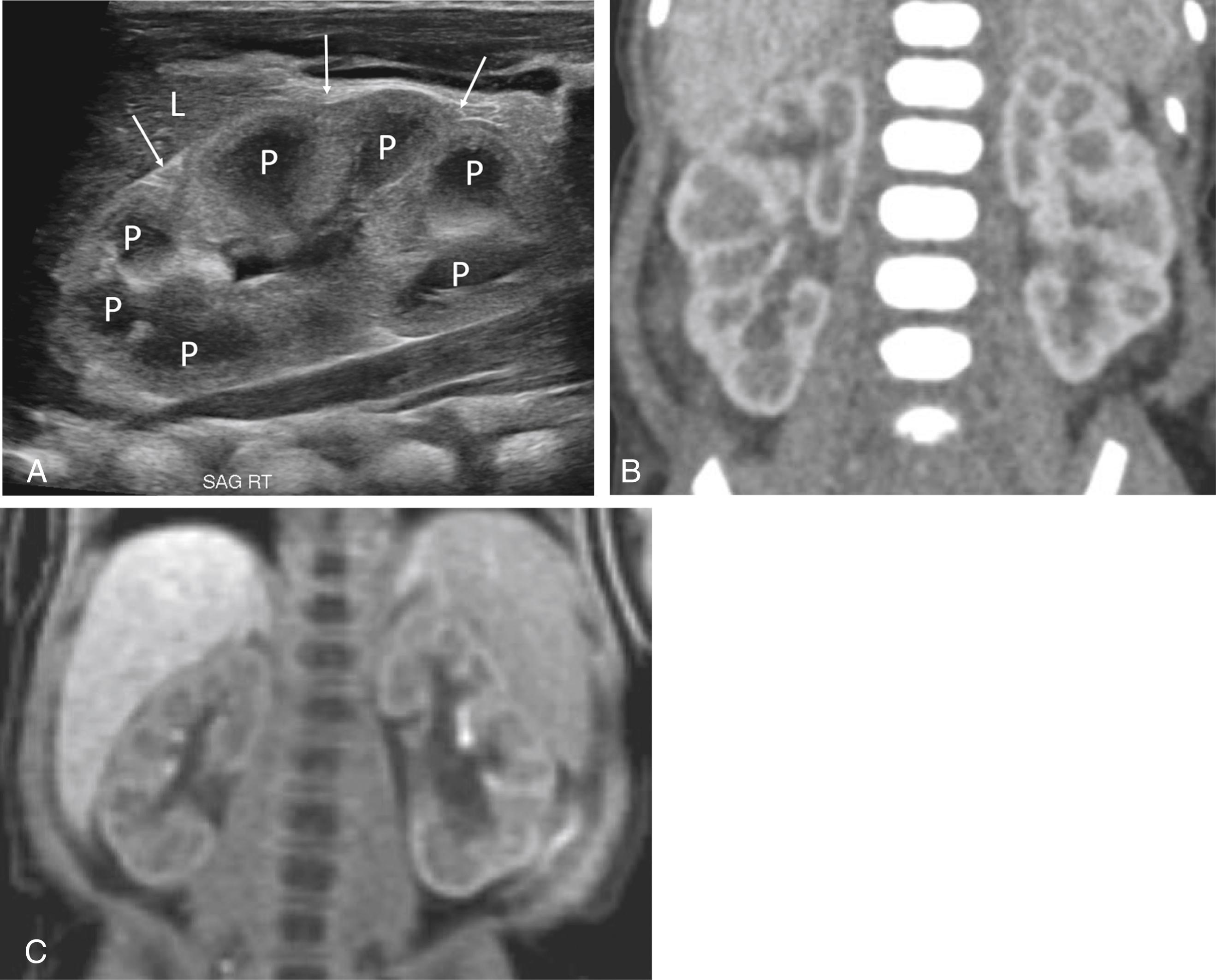 Figure 6-1, Normal imaging appearance of neonatal kidney.