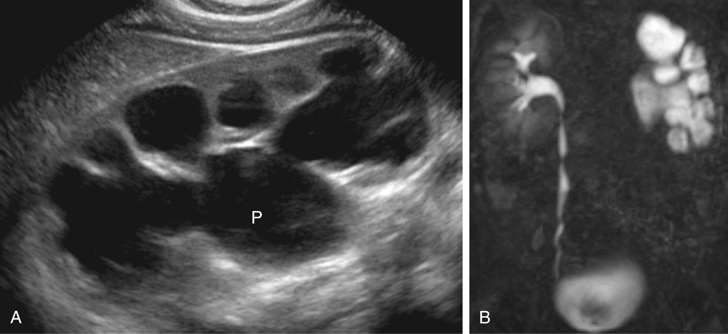 Figure 6-11, UPJ obstruction.