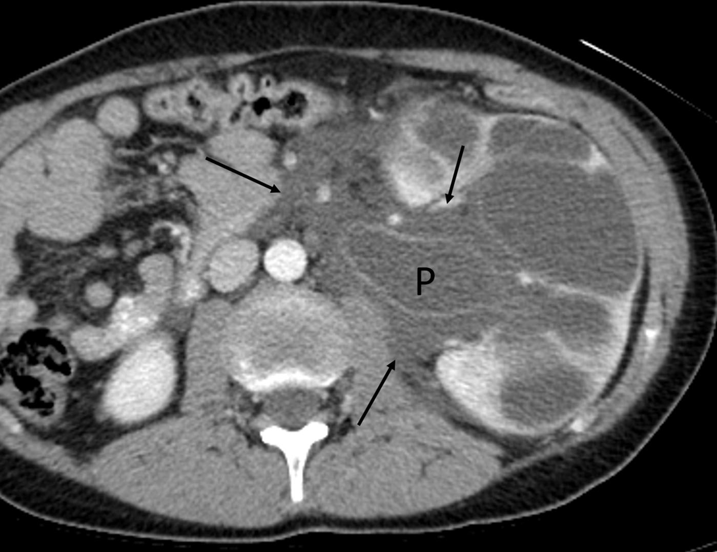 Figure 6-12, Renal injury to child with UPJ obstruction following trauma.