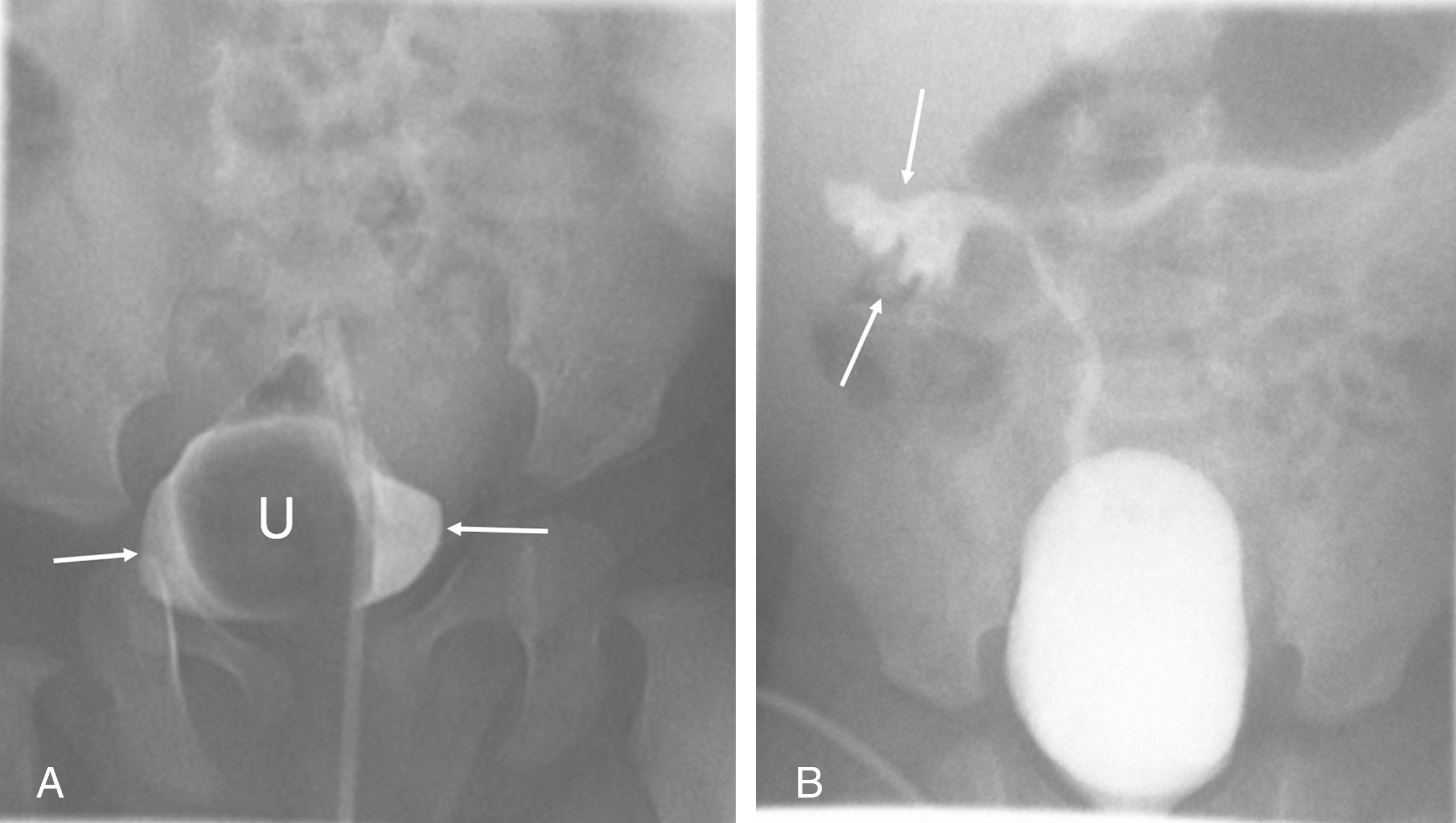 Figure 6-14, Duplicated right renal collecting system with ureterocele and VUR into lower pole moiety.