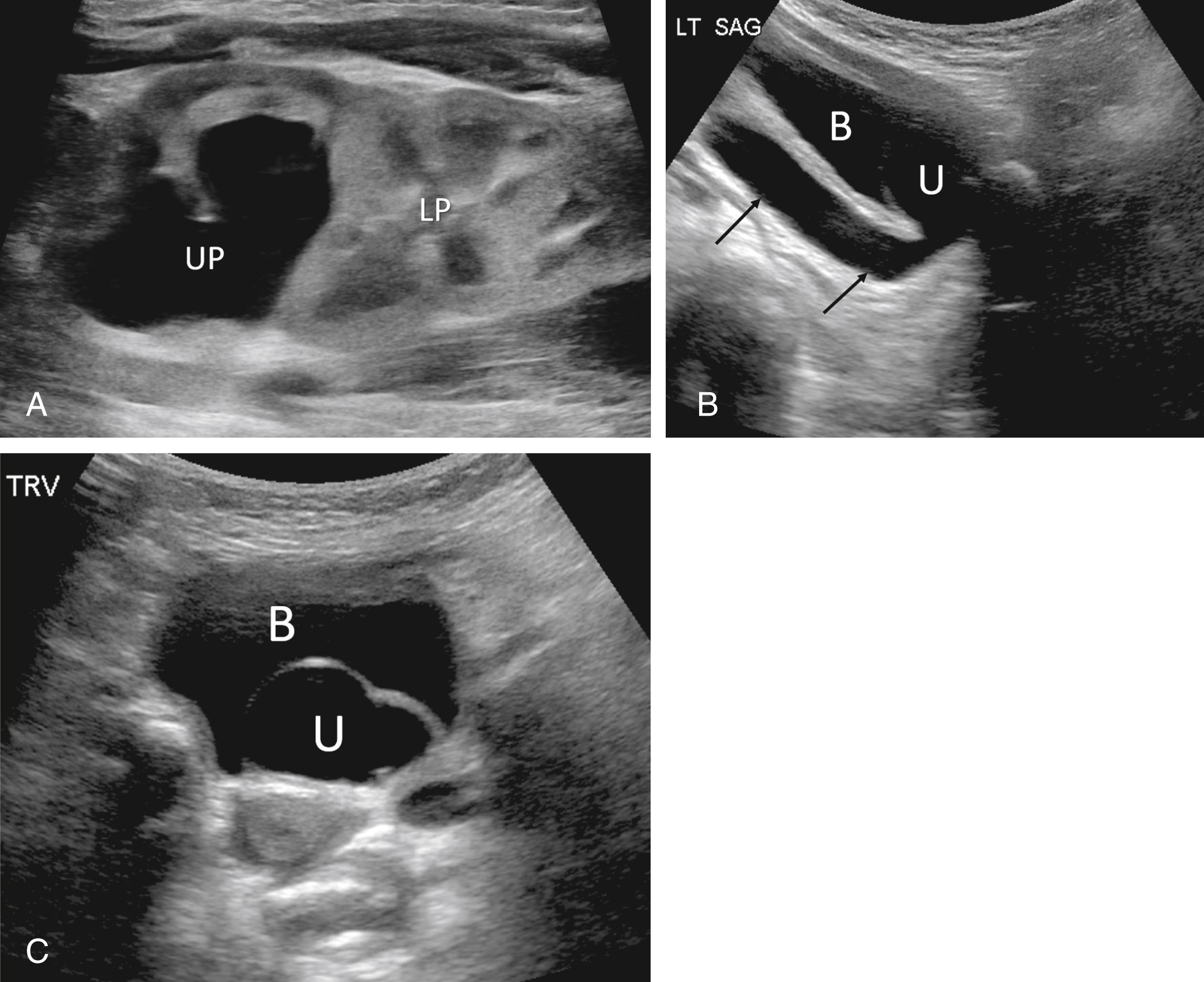 Figure 6-15, Duplicated left renal collecting system with ureterocele causing obstruction of the upper pole.