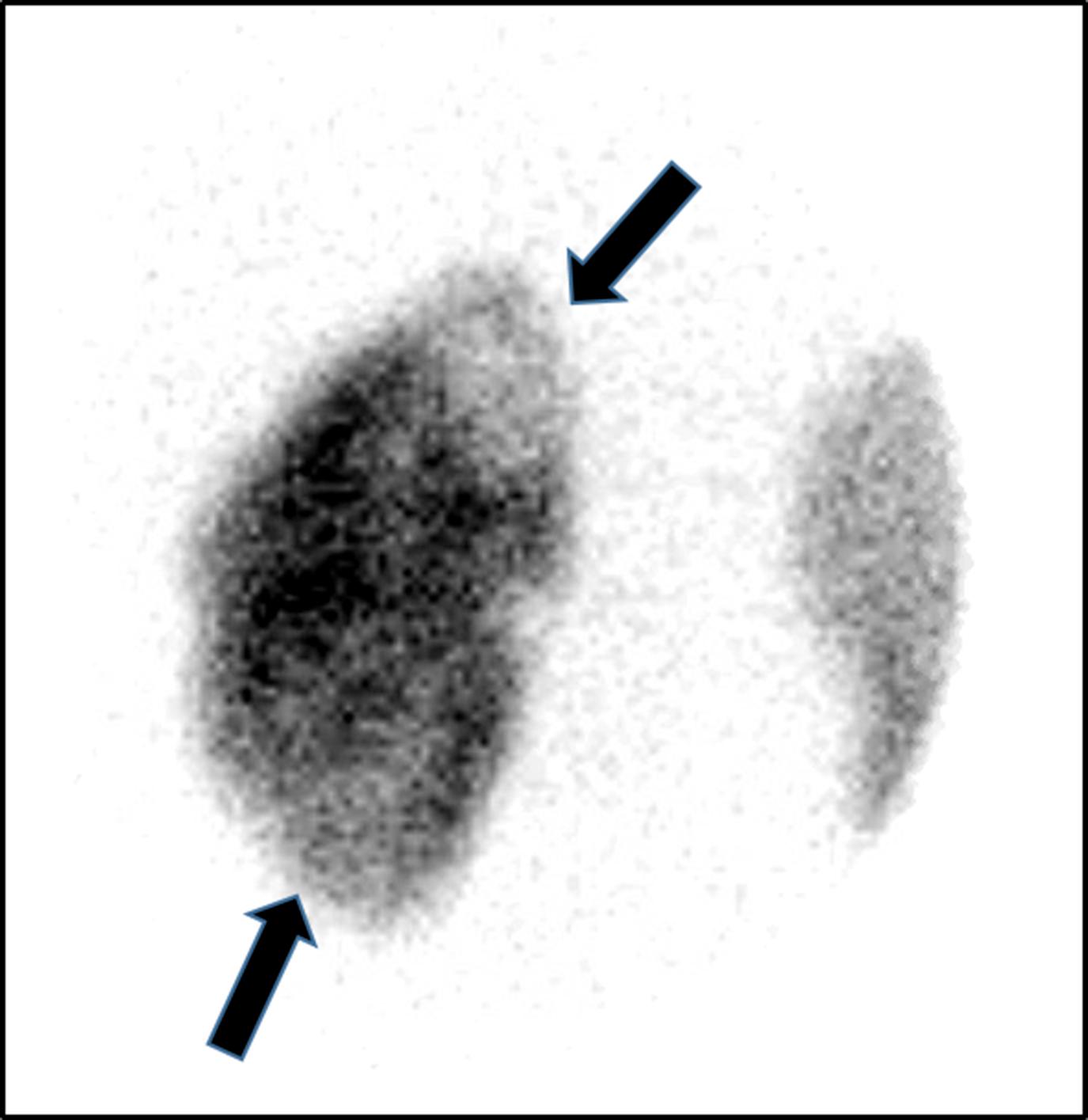 Figure 6-2, Acute pyelonephritis.