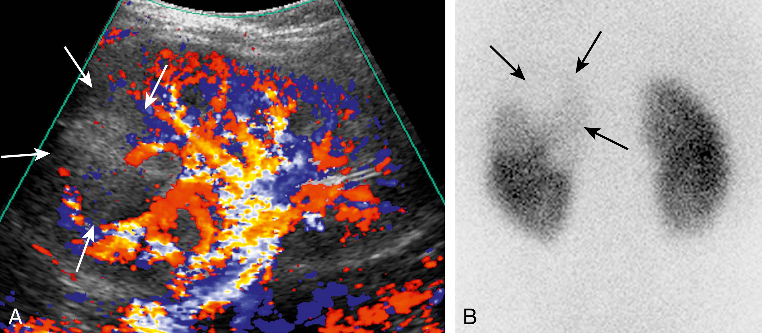 Figure 6-3, Acute pyelonephritis on Doppler ultrasound.