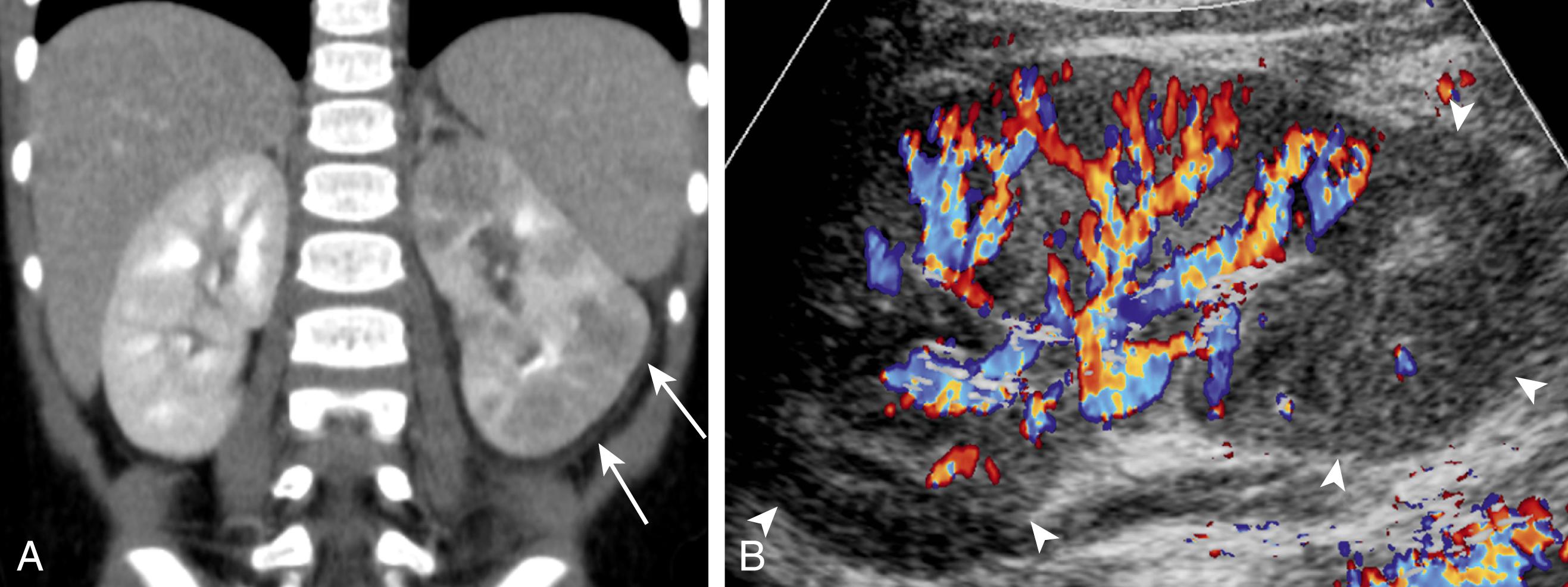 Figure 6-4, Acute pyelonephritis on CT obtained for abdominal pain.