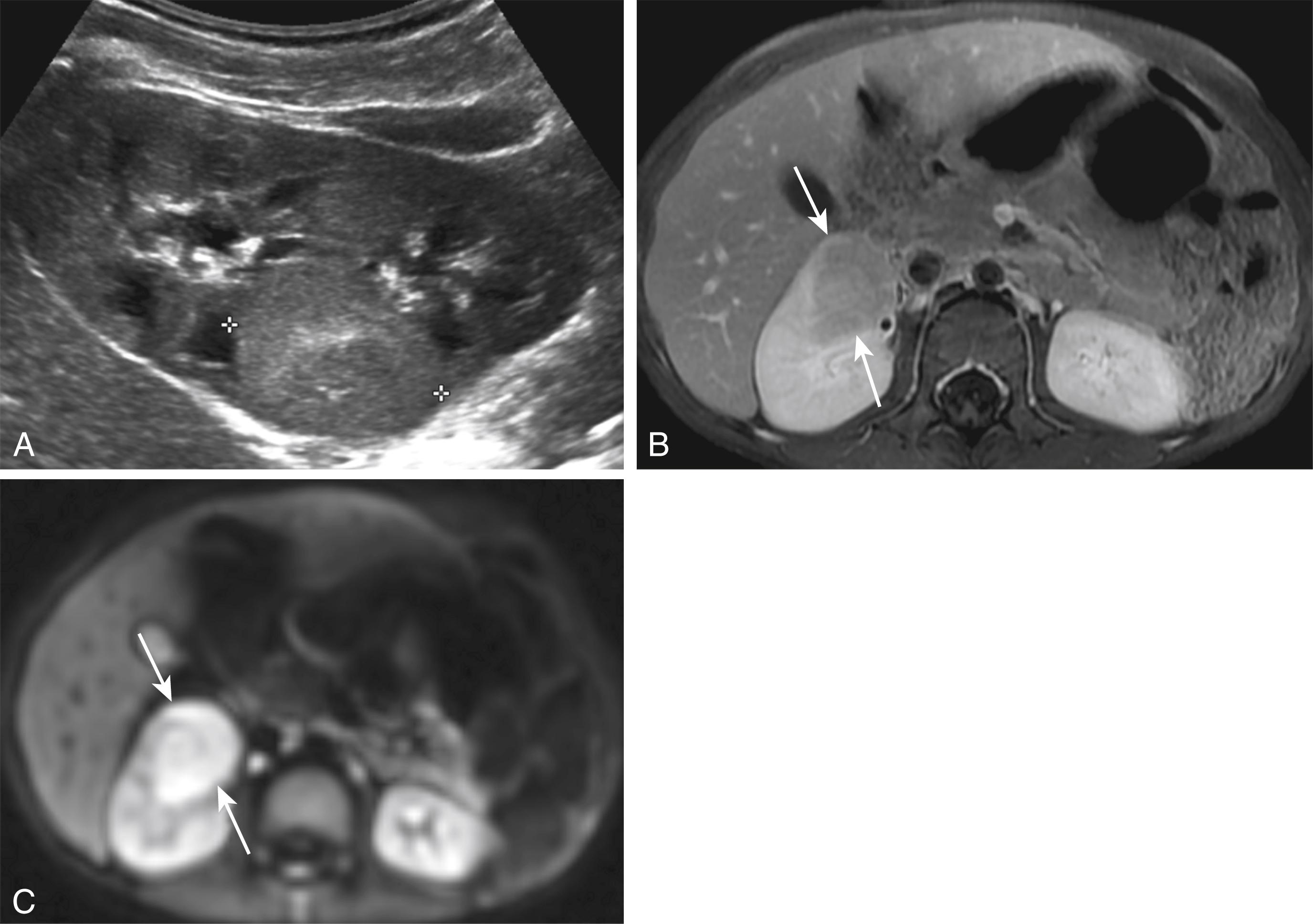 Figure 6-5, Acute, focal pyelonephritis presenting as a mass.