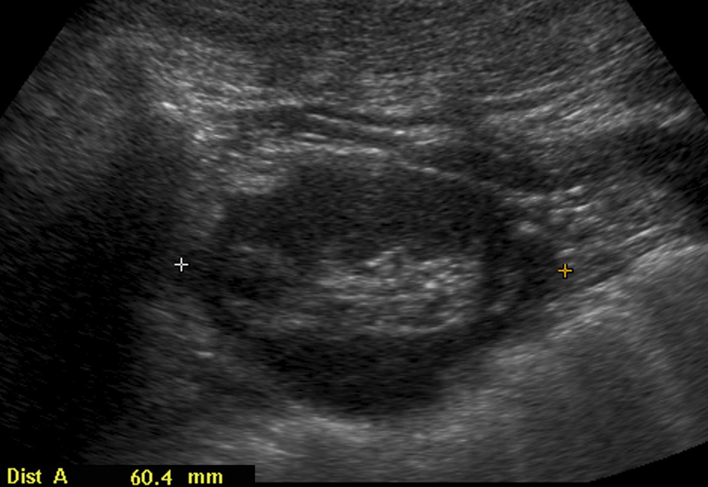 Figure 6-6, Left renal scarring in a 10-year-old girl with high-grade vesicoureteral reflux. Longitudinal ultrasound shows the left kidney is small for age and shows diffuse irregular thinning of the renal parenchyma, most striking in the upper and lower poles, in keeping with multifocal scarring.