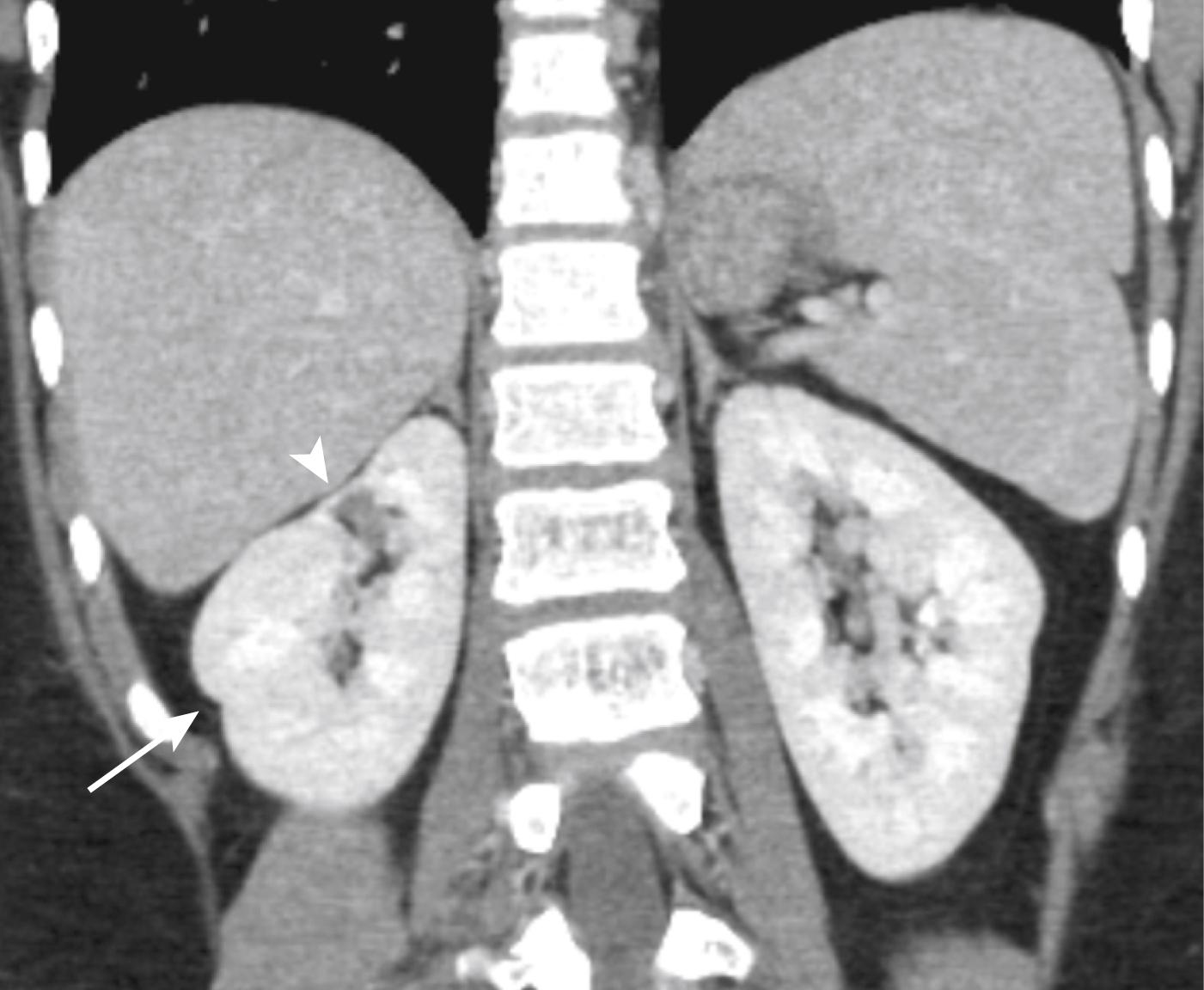 Figure 6-7, Differentiation between fetal lobulation and focal scarring; both are demonstrated in the same patient. Coronal contrast-enhanced CT shows indentation and thinning of the right upper pole renal cortex directly over the medullary pyramids ( arrowhead ). This area represents focal scarring. There is also an indentation in the renal cortex between the medullary pyramids ( arrow ). This is consistent with normal fetal lobulation.