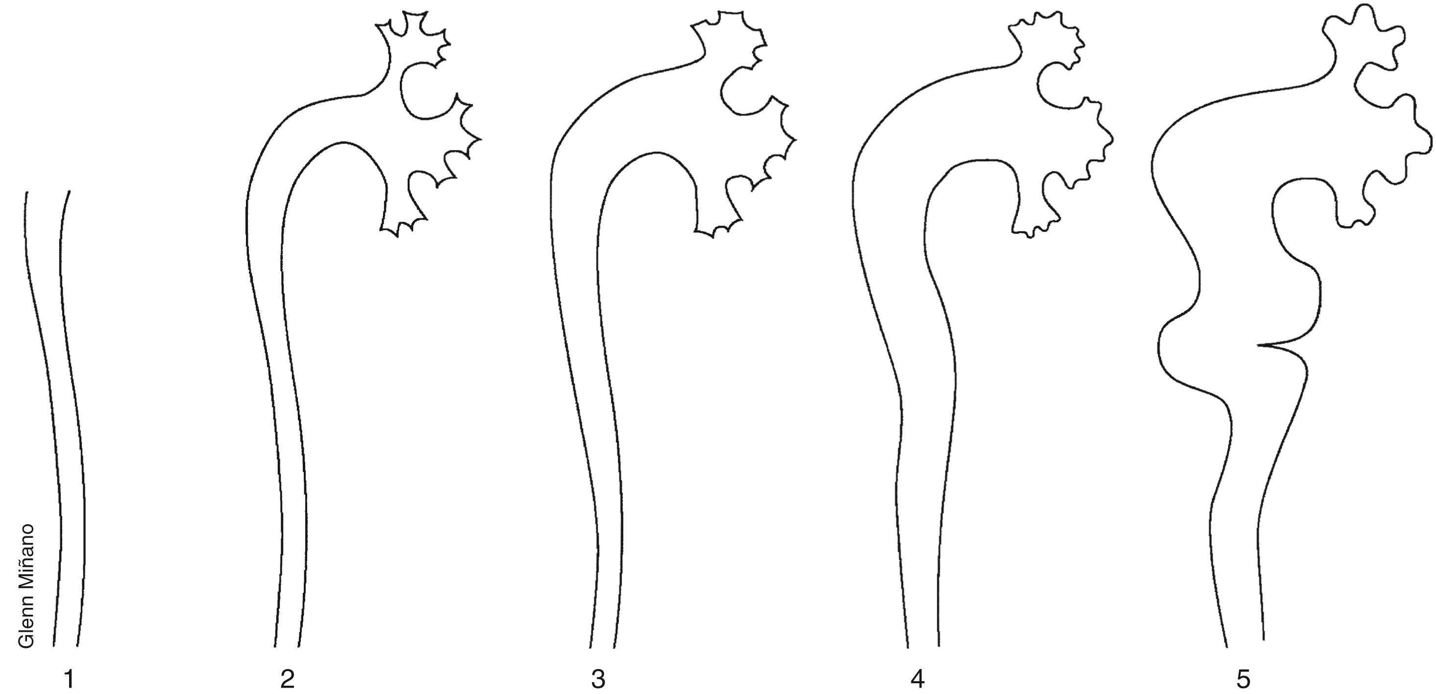 Figure 6-8, Grading system for VUR.