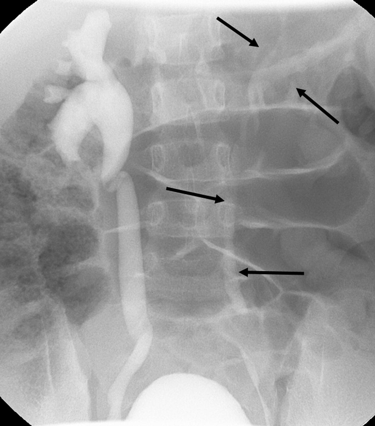 Figure 6-9, Bilateral VUR: right, grade 4, and left, grade 2.