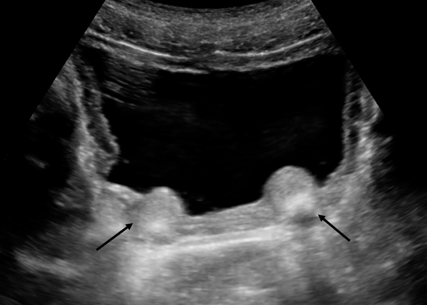 Figure 6-10, Ultrasound appearance following minimally invasive endoscopic treatment of VUR using periureteral injection of Deflux. Transverse ultrasound image shows bilateral echogenic mounds ( arrows ) at base of bladder in region of the ureterovesical junctions.