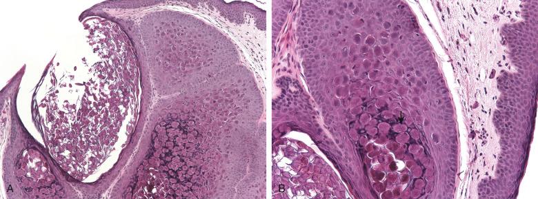 Figure 16.2, Molluscum contagiosum.