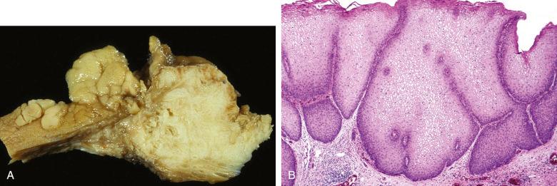 Figure 16.5, Bladder condyloma.