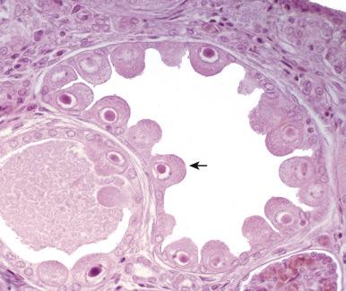 Figure 16.6, Cytomegalovirus acute interstitial nephritis. Characteristic eosinophilic intranuclear inclusions surrounded by a clear halo can be seen in enlarged renal tubular epithelial cells (arrow) .