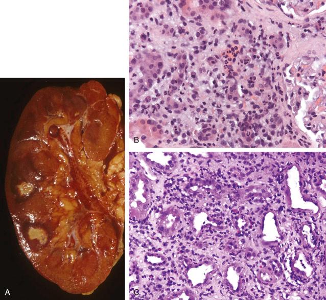 Figure 16.7, Acute pyelonephritis.