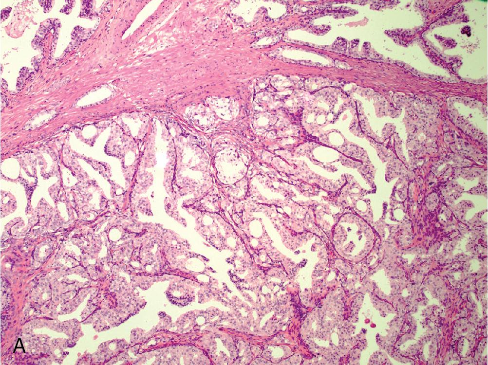 Fig. 5.20, Clear cell cribriform hyperplasia represents a spectrum of benign prostate hyperplasia and therefore is typically encountered in the transition zone of the prostate. In this transurethral resection specimen, there is a nodular proliferation of non-confluent large cribriform glands with clear to eosinophilic cytoplasm (A) . The cells forming the central lumina are cuboidal to low columnar secretory-type cells, with uniform round nuclei and clear cytoplasm. The glands are rimmed with a prominent basal cell layer (B) .