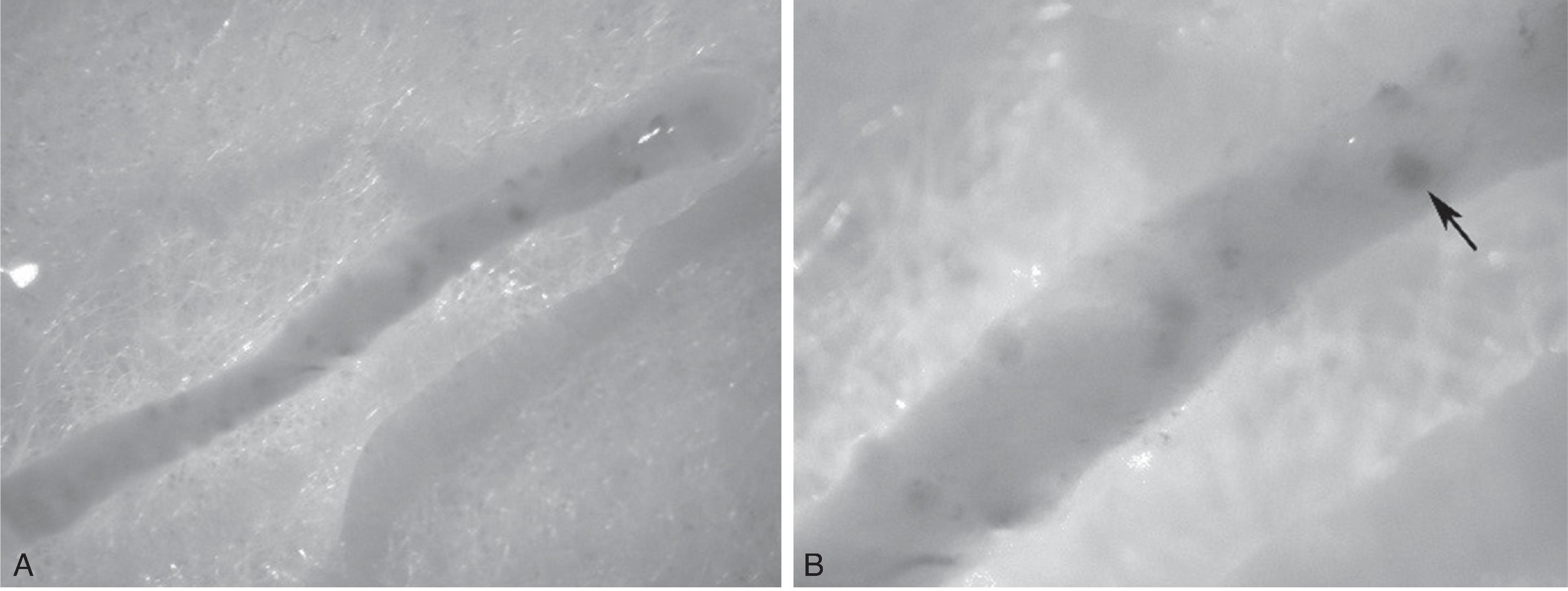 Figure 17.1, Appearance of kidney biopsies under a dissection microscope. A glomerulus (arrow) is a pink/red, slightly raised nodule in a pale tan background when fresh unfixed cores are viewed under a dissecting microscope. A. Low power. B. High power.