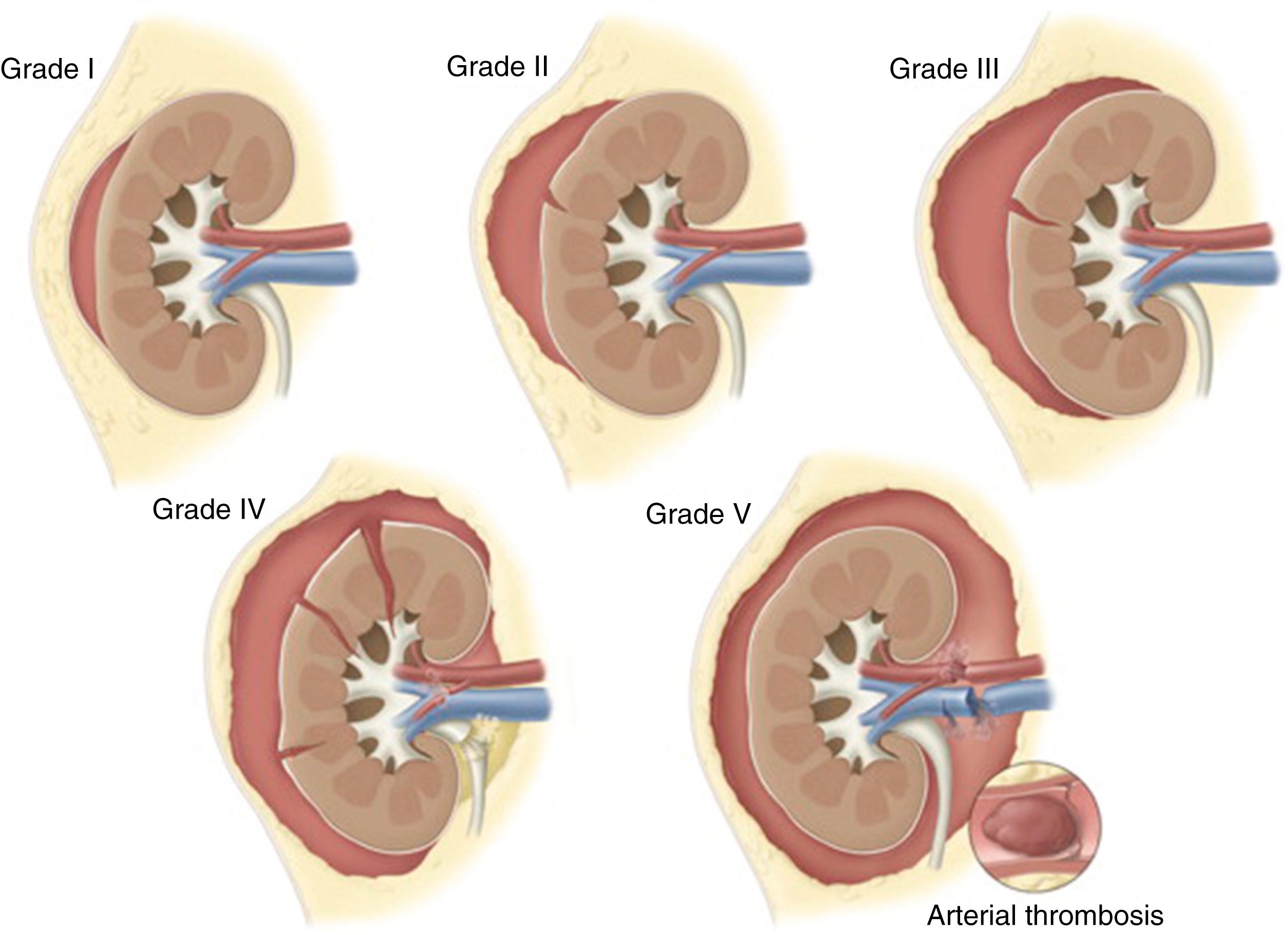 Fig. 39.6, Schematic of the American Association for the Surgery of Trauma (AAST) grading scale for renal trauma.