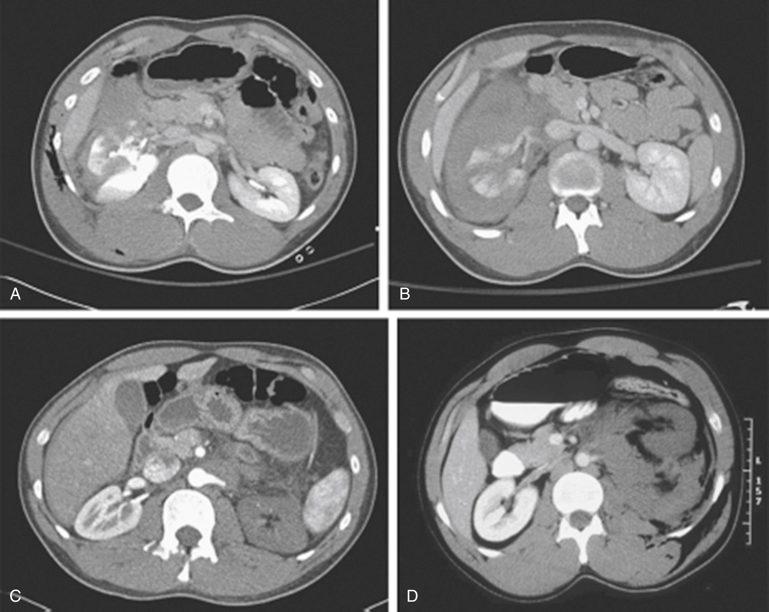 Fig. 39.8, High-grade Renal Injuries.