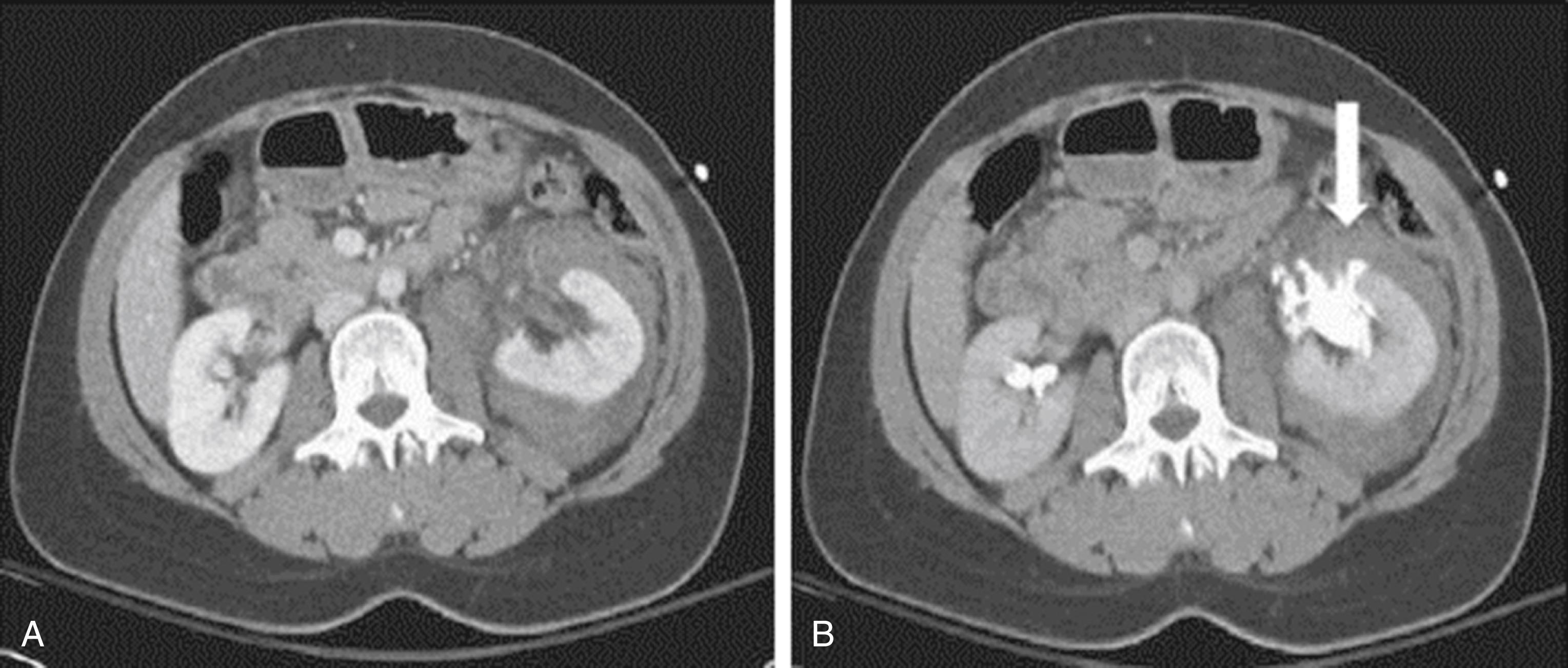 Fig. 39.9, (A) Left-sided perinephric fluid collection suggests a collecting system injury on computed tomography (CT) images. (B) Delayed images confirm a collecting system injury with contrast extravasation (arrow) .