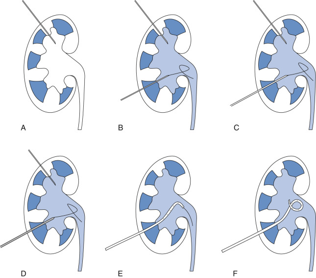 Figure 73-2, Schematic illustration of PCN using Seldinger technique. A, Posterior calyx is punctured with 22 G needle under US guidance. B, After performing antegrade pyelography through this access point with contrast material injection, second 22 G needle is inserted into opacified collecting system along expected tract of nephrostomy catheter. 0.018-inch wire is advanced through this needle. C, Exchange is made for catheter that allows conversion to 0.035-inch wire. D-E, Nephrostomy tract is dilated by exchanging successive dilators over wire. F, Pigtail loop of PCN is formed and wire is removed.