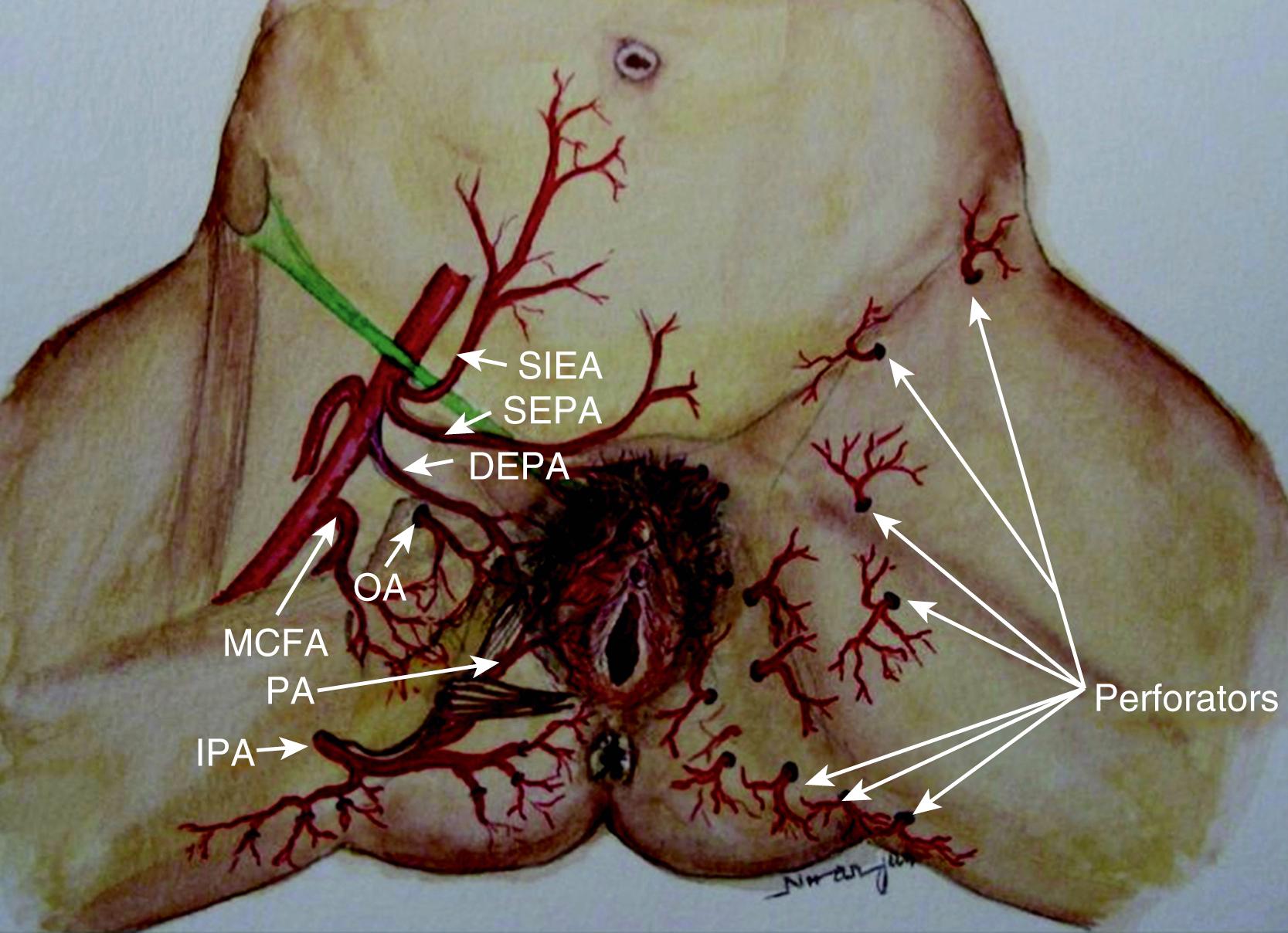 Fig. 41.1, Blood supply of the perineum. SIEA, superficial inferior epigastric artery; SEPA, superficial external pudendal artery; DEPA, deep external pudendal artery; OA, obturator artery; MCFA, medial circumflex femoral artery; PA, perineal artery; IPA, internal pudendal artery