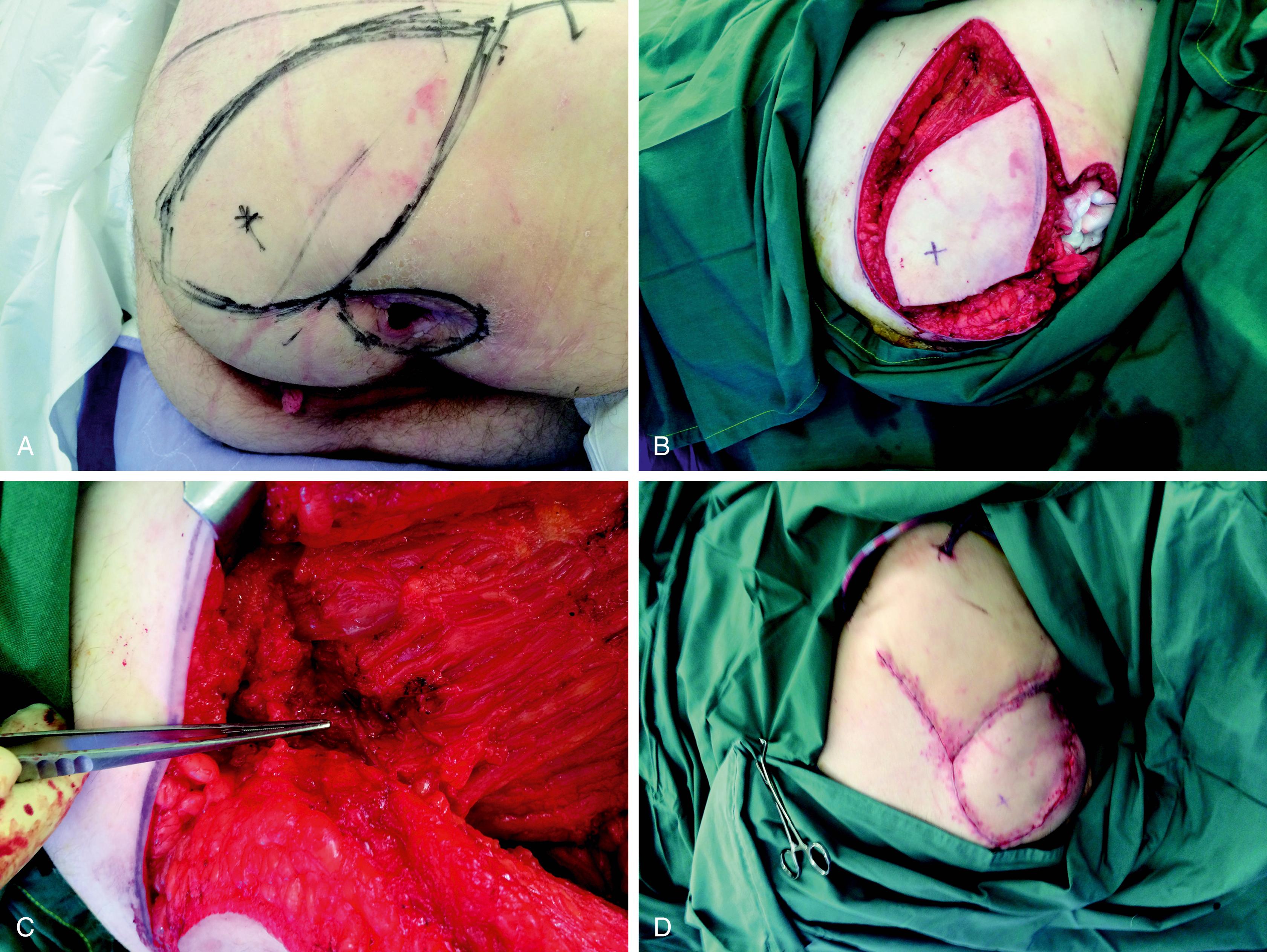 Fig. 41.11, Superior gluteal artery flap, islanded transposition flap. (A) Reverse flap design around the perforator. (B) Islanded flap. (C) Perforator isolation and dissection through the muscle towards the pelvis. (D) Transposition, inset, and closure of donor site.