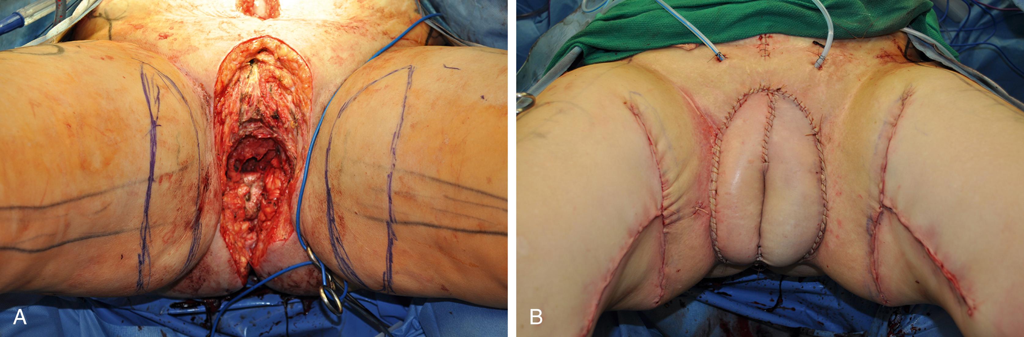 Fig. 41.13, Transverse upper gracilis (TUG) flap for total vaginal reconstruction. (A) Defect after oncological resection and flap design. (B) Final flap inset with donor site closed.