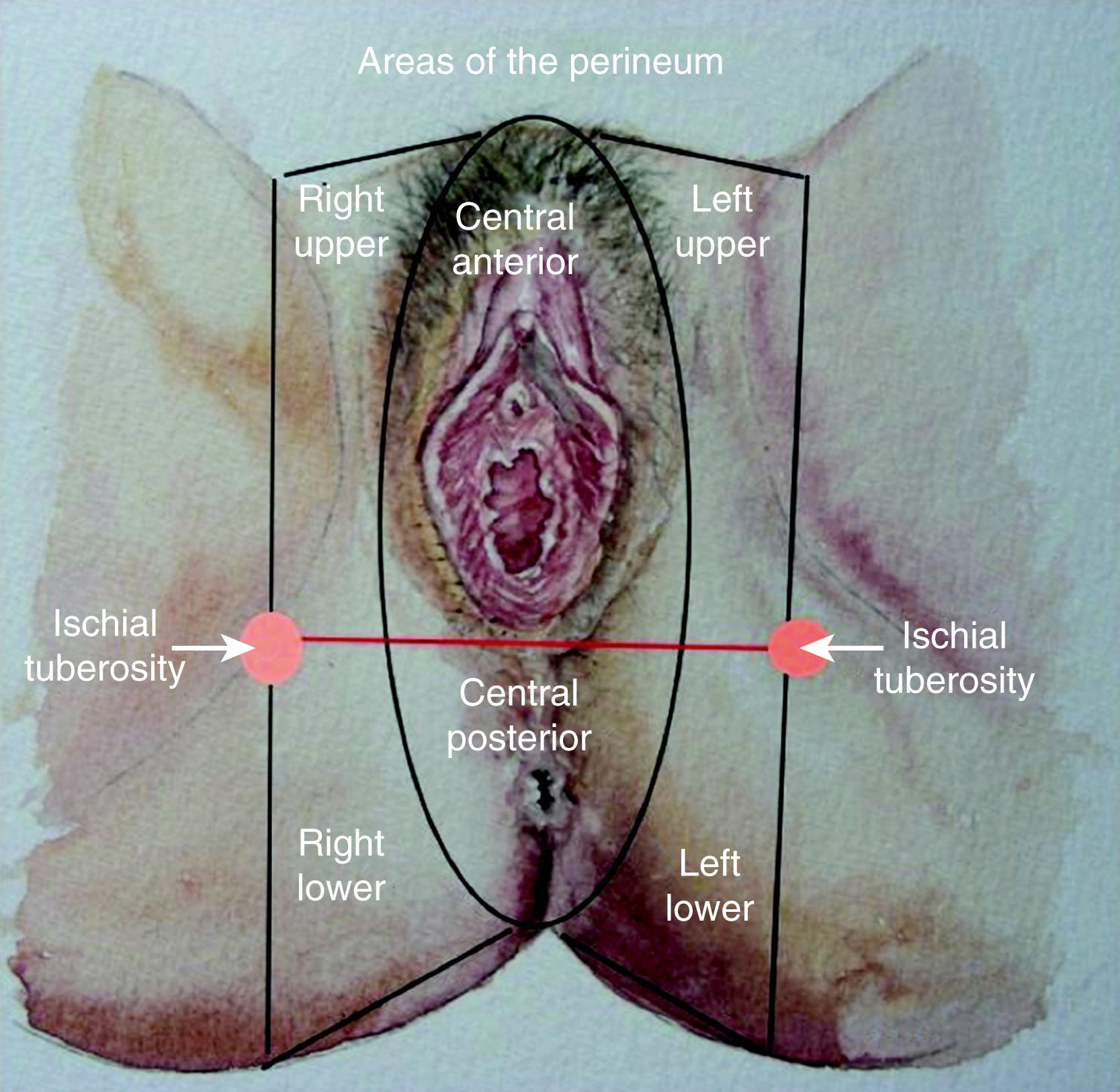 Fig. 41.2, Schematic division of the perineum.