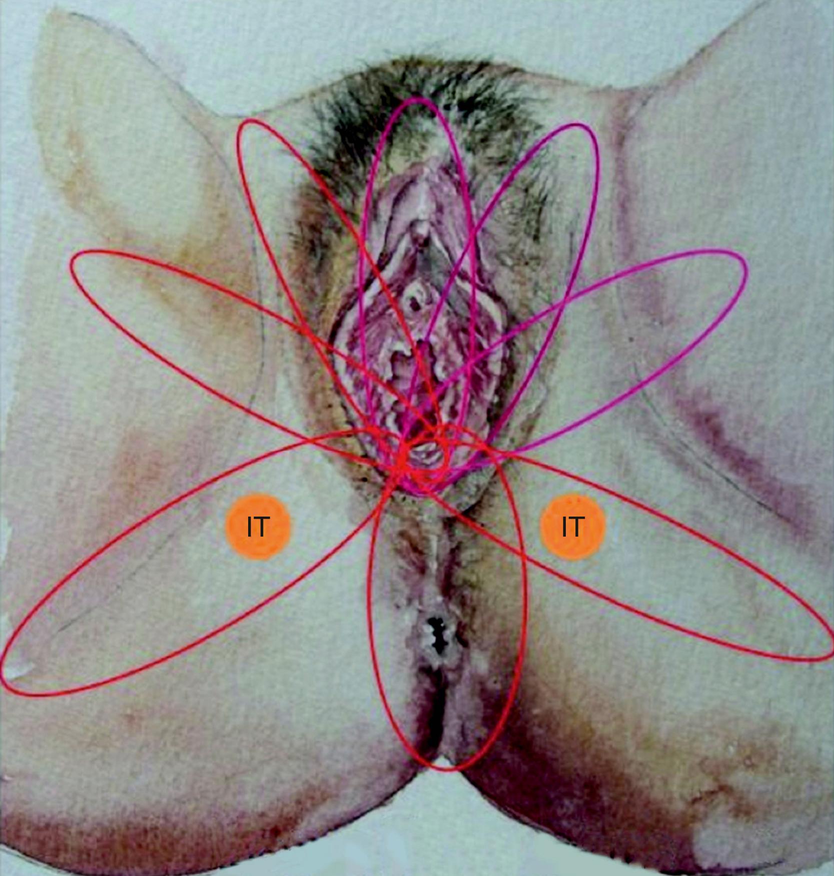 Fig. 41.3, Lotus flap schema based on local perforators. IT, ischial tuberosity.