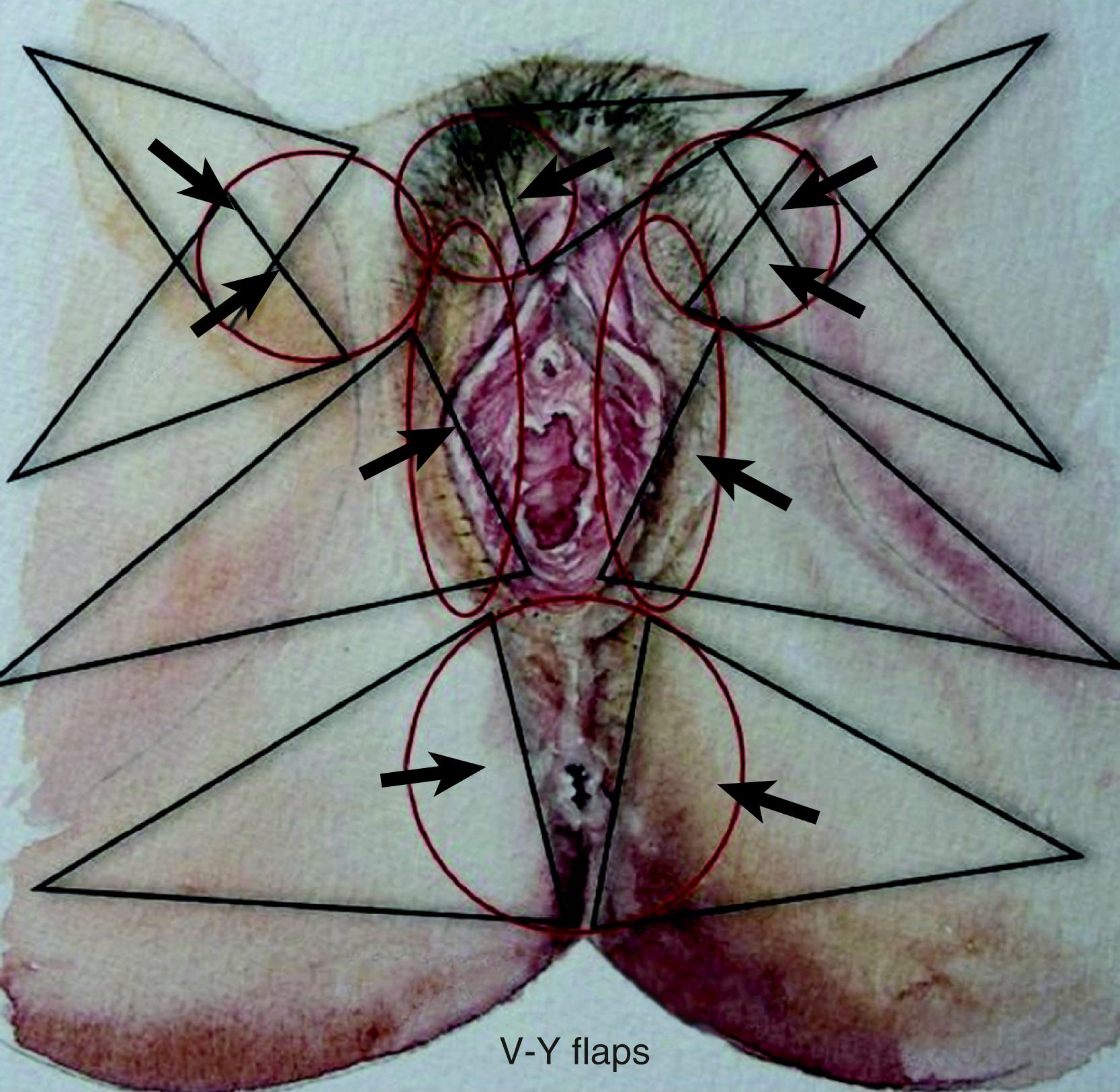 Fig. 41.4, V–Y advancement flap.