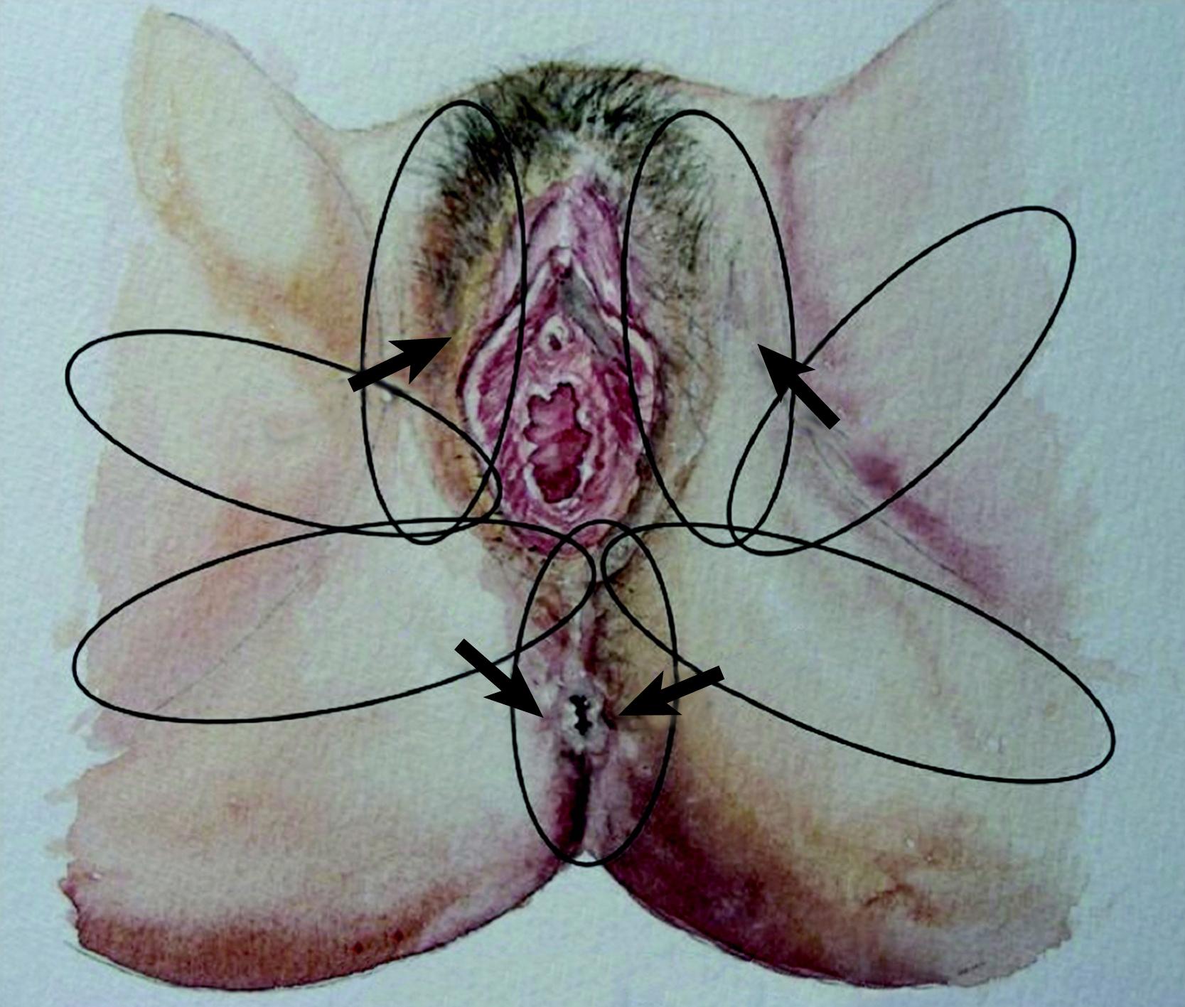 Fig. 41.5, Transposition of pudendal and mons pubis flaps.