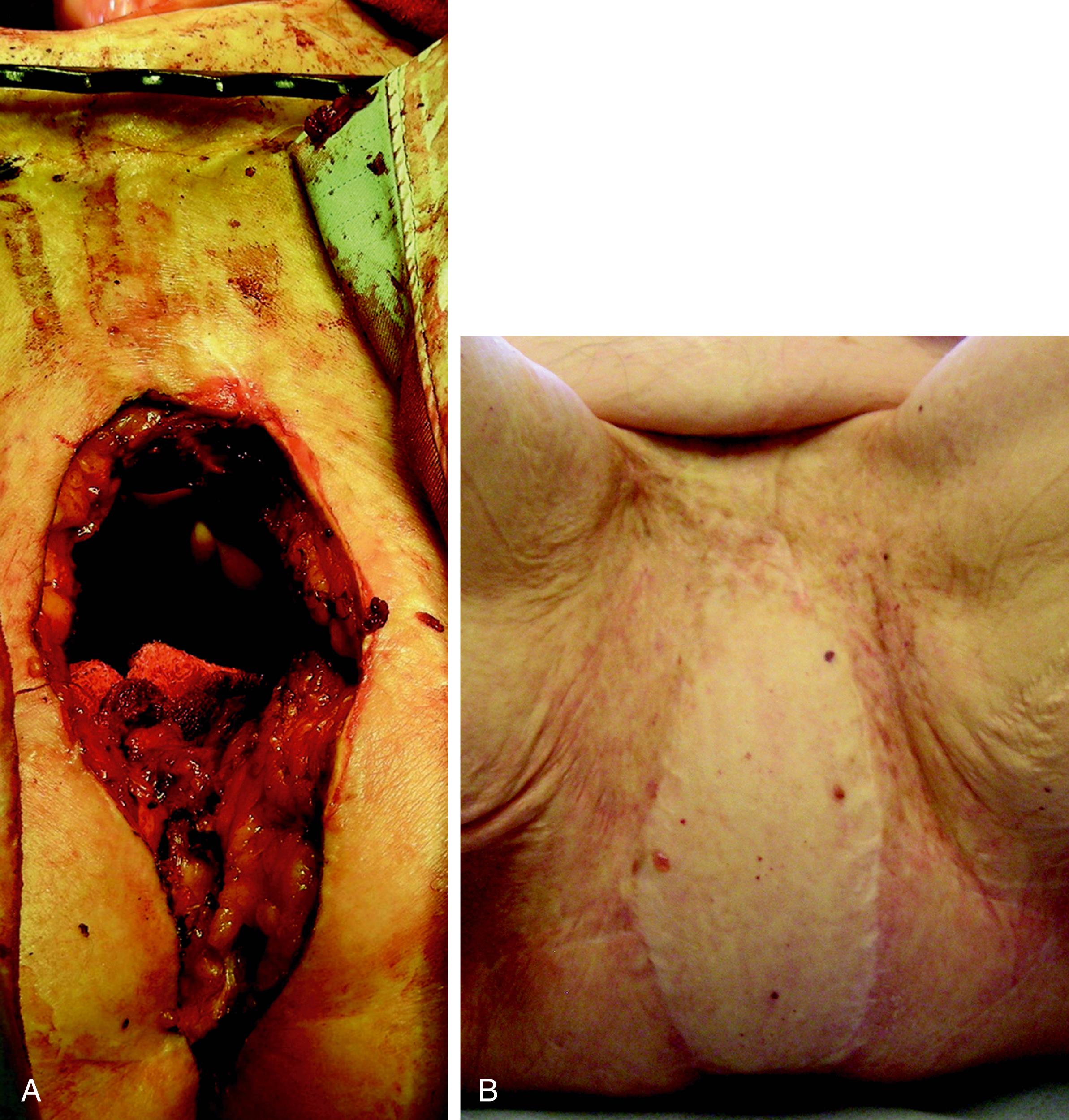 Fig. 41.8, VRAM flap. (A) Defect following total perineal resection. (B) Five-year follow-up.