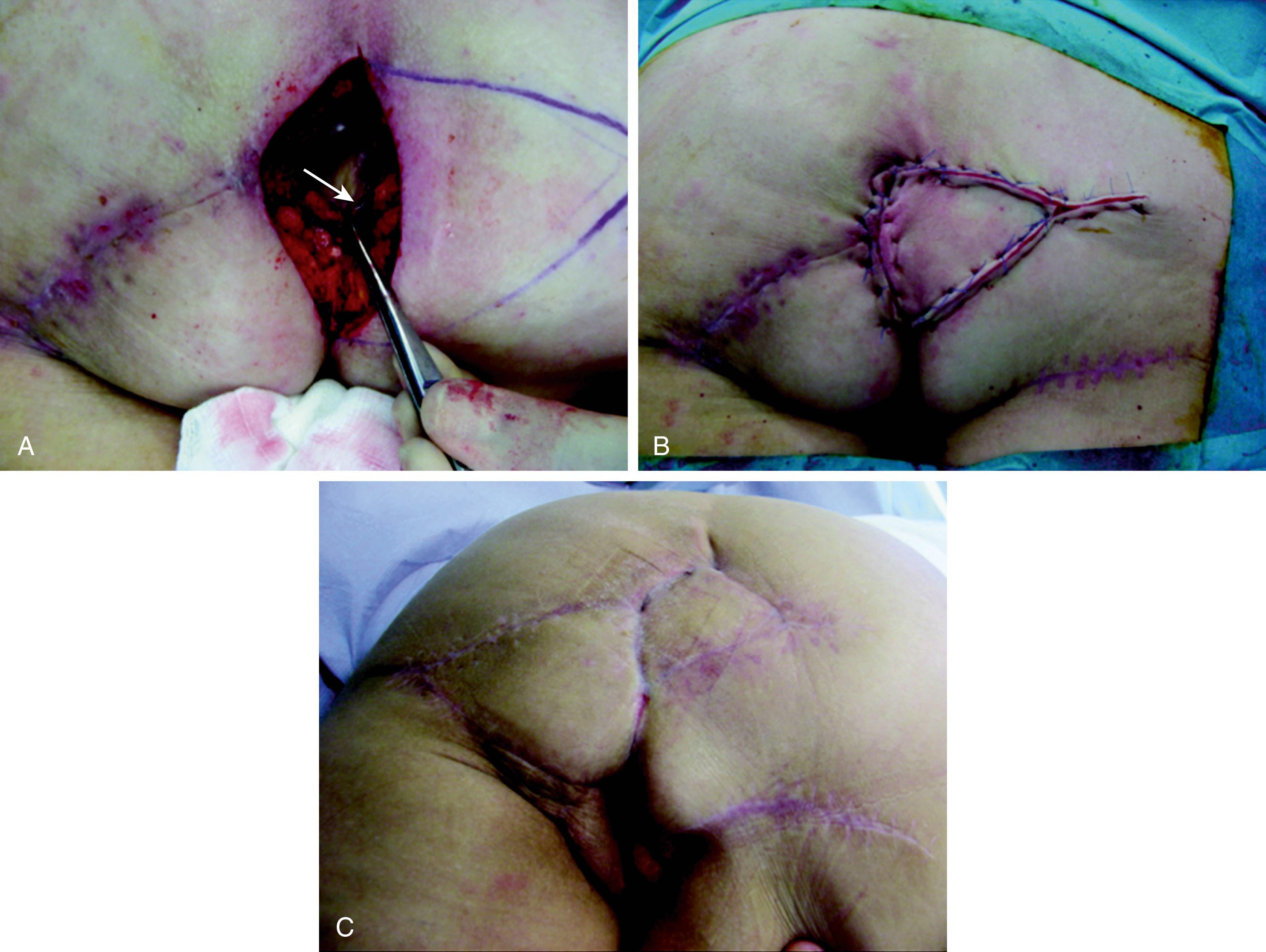 Fig. 41.10, Inferior gluteal artery flap, island flap V–Y advancement. (A) Postperineal reconstruction wound showing intact gluteal fold flap. (B) Immediate postoperative result. (C) Three months postoperative result.