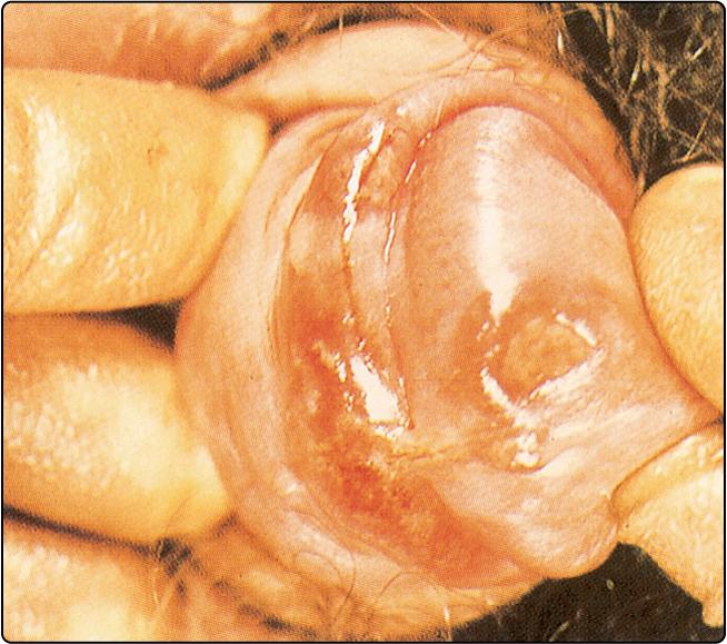 Fig. 70.1, Primary chancre of syphilis.