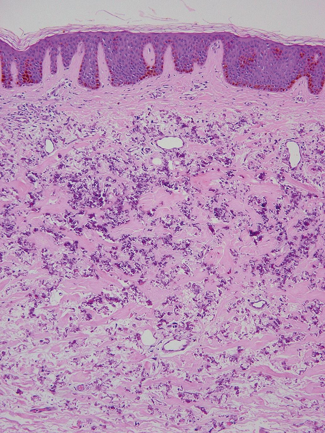 Fig. 12.1, Pseudoxanthoma elasticum