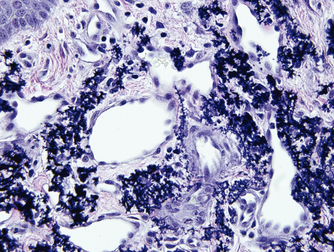 Fig. 12.2, “Bramble bush” elastic fibers induced by penicillamine