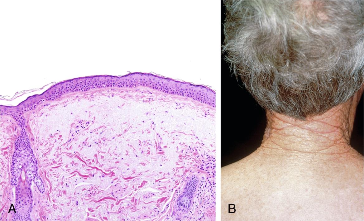 Fig. 58.1, A, Severe solar elastosis. The pale, light blue-gray material in the superficial dermis has largely replaced the normal highly eosinophilic collagen bundles. Also note the loss of the normal rete pegs in the epidermis (hematoxylin and eosin [H&E]). B, Cutis rhomboidalis nuchae. Severe solar elastosis and wrinkling of the posterior neck secondary to sun exposure that clearly demarcates from more–normal-appearing skin that is less sun-damaged.