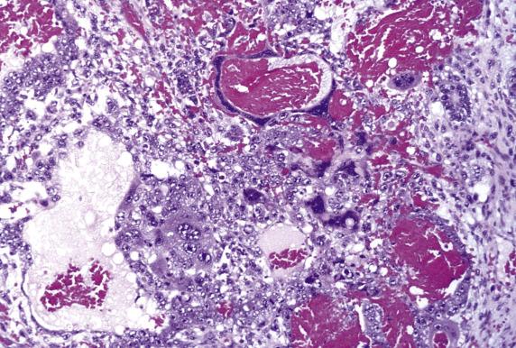 FIG. 16.11, Embryonal carcinoma. Scattered syncytiotrophoblast cells can be present, sometimes in a hemorrhagic background.