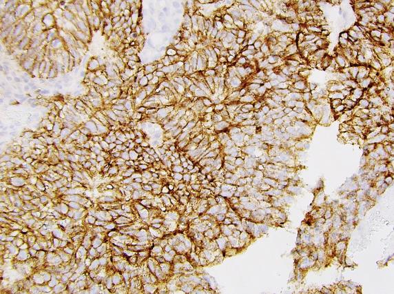 FIG. 16.12, Embryonal carcinoma. Tumor shows strong and diffuse membranous CD30 staining.