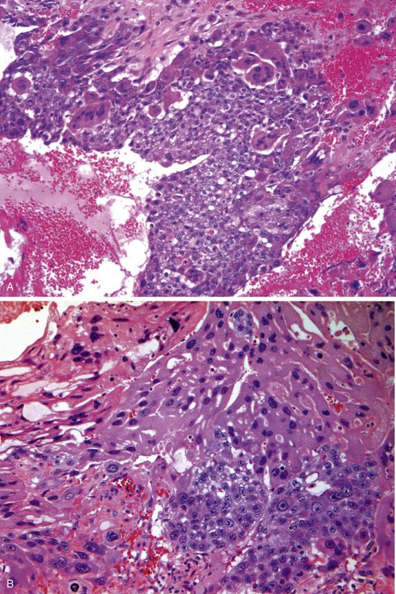 FIG. 16.13, Nongestational choriocarcinoma. Sheets of atypical cells, some large and multinucleated with eosinophilic cytoplasm (syncytiotrophoblast), are admixed with more numerous smaller polygonal mononuclear cells (cytotrophoblast) (A). Biphasic appearance, featuring syncytiotrophoblast (upper left aspect) and cytotrophoblast (lower right aspect), is apparent (B).