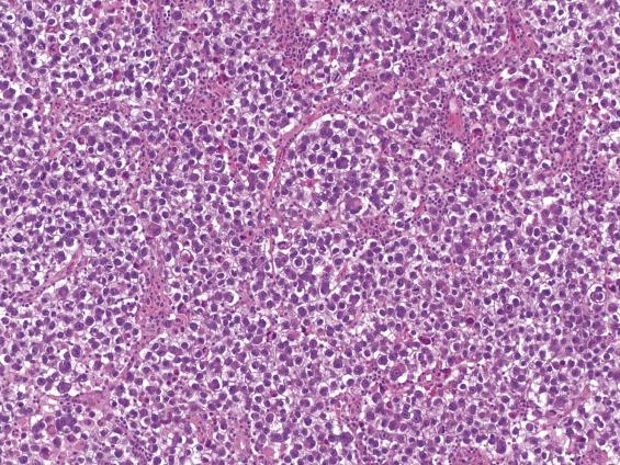 FIG. 16.2, Dysgerminoma. A monotonous population of large cells separated by thin fibrous septa containing numerous lymphocytes.