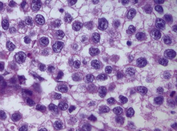 FIG. 16.5, Dysgerminoma. Tumor cells have abundant clear to eosinophilic cytoplasm and large central nuclei, sometimes with a “squared-off” contour and prominent nucleoli. Notice the distinct cell borders, identifiable at high-power magnification.