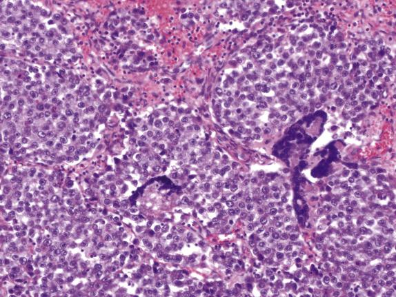 FIG. 16.6, Dysgerminoma. Scattered syncytiotrophoblast cells are seen in a subset of tumors.