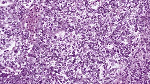 FIG. 16.8, Embryonal carcinoma. Highly atypical tumor cell population, mostly in solid sheets with poorly formed spaces and focal necrosis (upper left) .